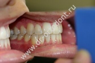 Взрослая ортодонтия: Нарушения прикуса