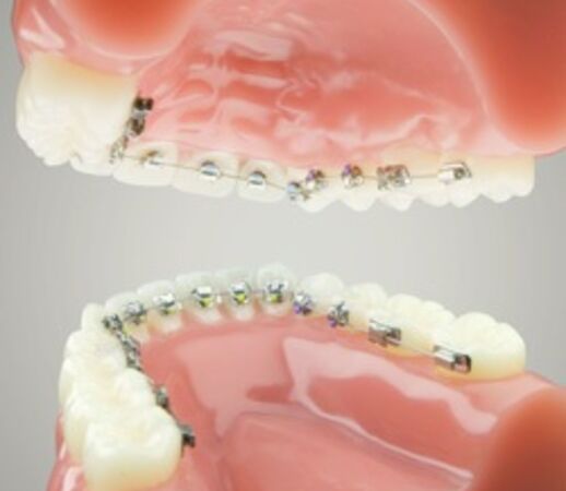 Взрослая ортодонтия: Лингвальные брекеты