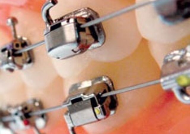 Взрослая ортодонтия: Что важно знать пациенту с брекетами